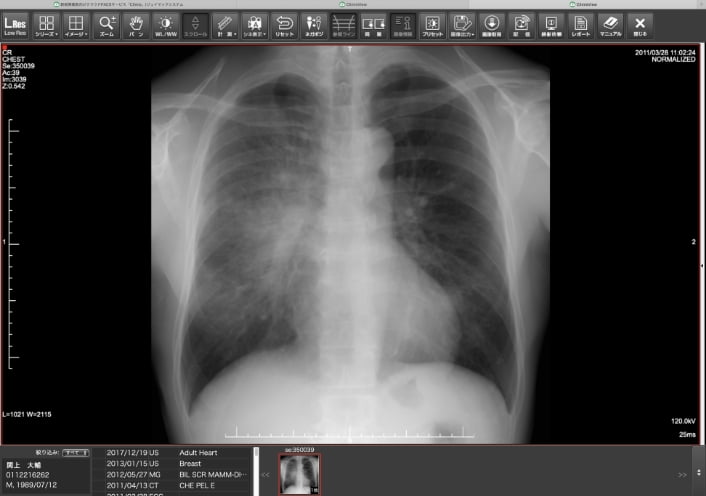 胸部X線画像表示例